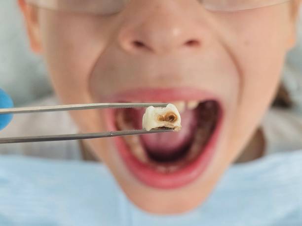 Best Same-Day Emergency Dental Services in East Bangor, PA