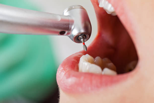 Best Emergency Treatment for Dental Infections or Abscesses in East Bangor, PA